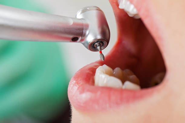 Best Emergency Tooth Extraction in Shady Hollow, TX